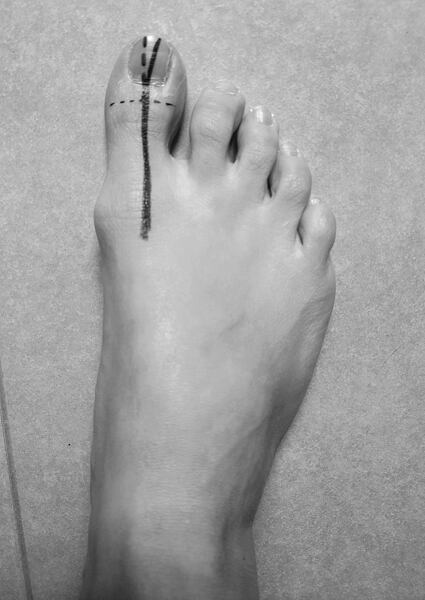 Pohled na pravé chodidlo a jak má vypadat srovnaný palec (i s nehtovým lůžkem).  Na fotce je vidět odchylka, kdy nehtové lůžko uhýbá mírně doprava (tedy k ostatním prstům na noze).