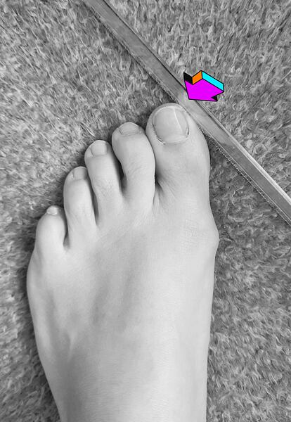 Pohled na levé chodidlo, kdy pro ukázku do palce jako vněšjší síla mí tlačí pravítko, které tak palec deformuje (podobně jako konvenční boty s úzkou špičkou) a tiskne k dalším prstům na noze. 
