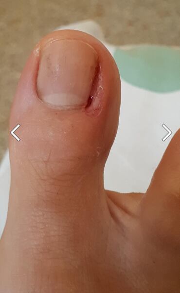 Nehet fyzioterapeutky po neustálých mikrozákrocích. Na vnitřní části palce, směrem k ostatním prstům, je vidět výrazné narušení kůže, která je jakoby vykousnutá.