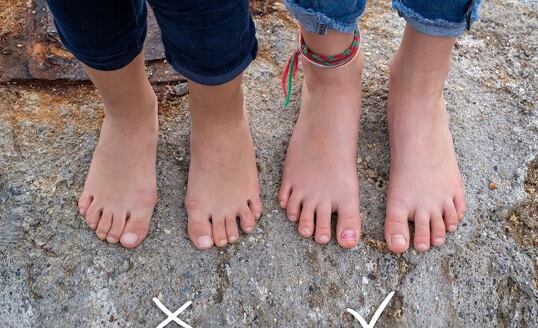 Ako vrátiť chodidlu jeho prirodzený tvar?