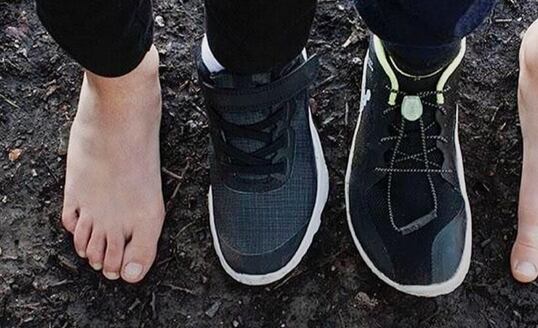 Vbočené palce - hallux valgus