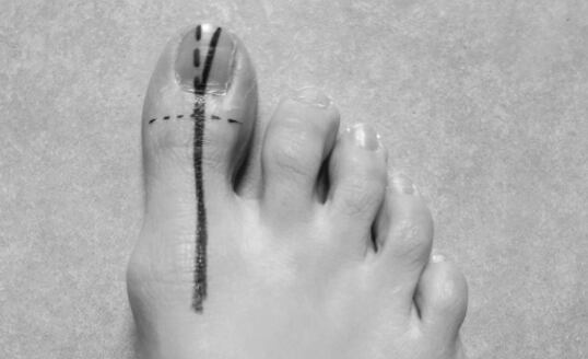 Zarůstající nehty - jak mohou pomoci barefoot boty